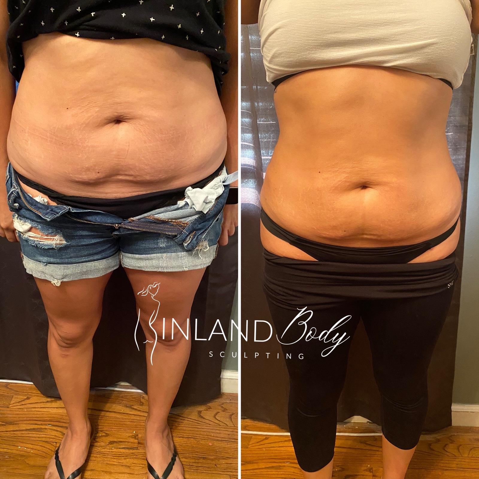 THE BEST 10 Body Contouring in ONTARIO, CA - Last Updated March 2024 - Yelp